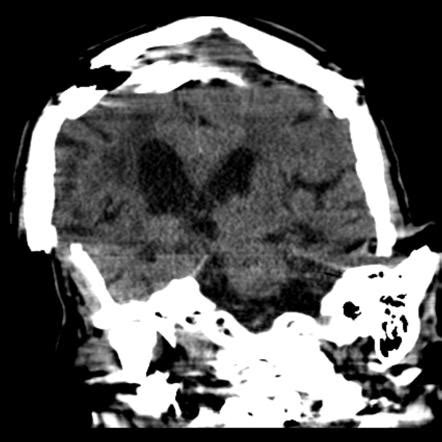 Motion Artifact Radiology Reference Article Radiopaedia Org