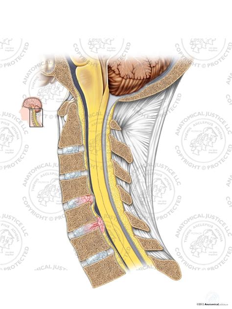 Cervical Disc Bulge And Herniation No Text