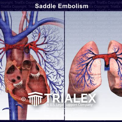 Saddle Embolism Trialexhibits Inc