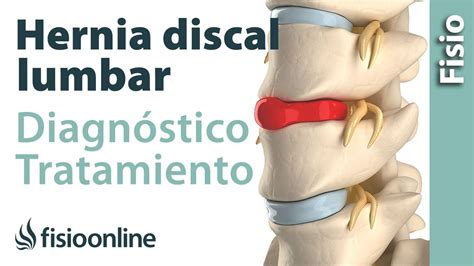 Hernia Discal Lumbar Diagnóstico Consejos Ejercicios Y Tratamiento