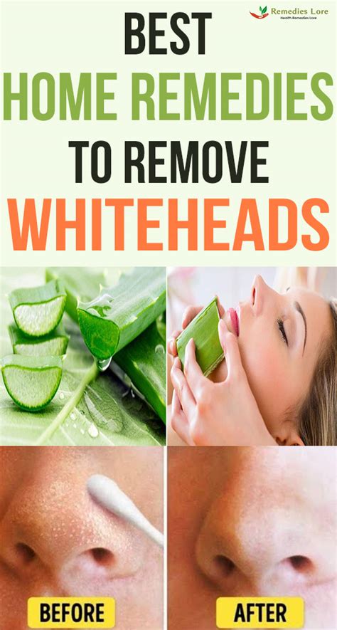 Best Home Remedies To Remove Whiteheads Remedies Lore