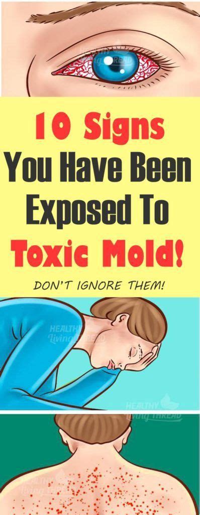 If you have a mold allergy, you can expect difficult symptoms such as nasal congestion, watery eyes, and a whole lot more. 10 Signs You Have Been Exposed To Toxic Mold! | Toxic mold ...
