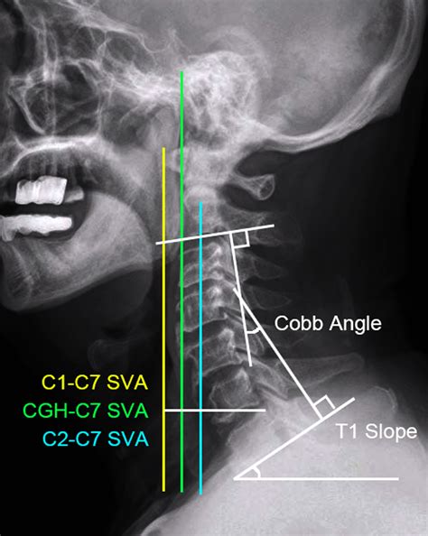 The Relationship Between Preoperative Cervical Sagittal Balance And