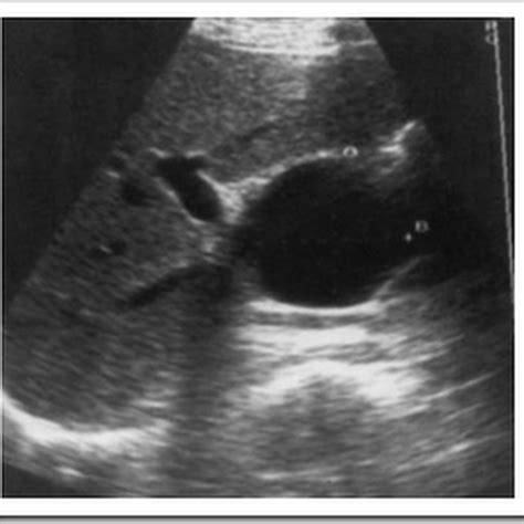 Ultrasound Images Choledochal Cyst Paediatric Abdomen Radiology Imaging