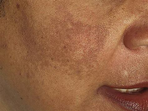Melasma On Black Skin Causes Treatment And More Medical News Today