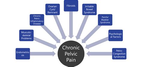5 Facts About Pelvic Congestion Syndrome Center For Vascular Medicine