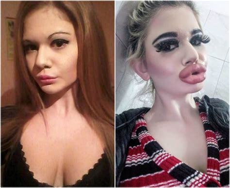 Woman Receives 17 Injections To Have Biggest Lips In The World