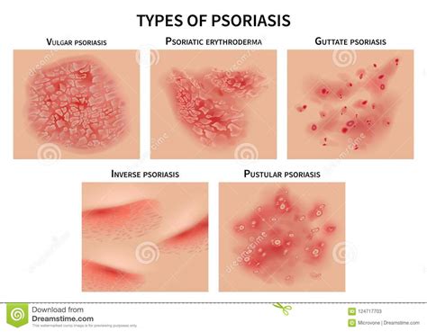 Psoriasis Types Skin Hives Derma Diseases Stock Vector Illustration