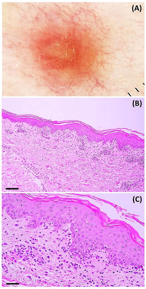 Frontiers Case Report Pityriasis Rosea Like Eruption Following Covid