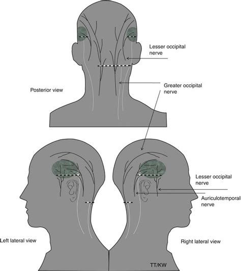 Greater Occipital Nerve Entrapment Springerlink
