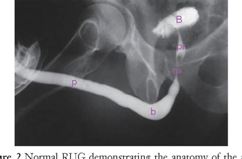 Figure 6 From Imaging Of Urethral Stricture Disease Semantic Scholar