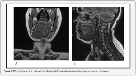 Ectopic Thyroid With Multinodular Goiter Case Report
