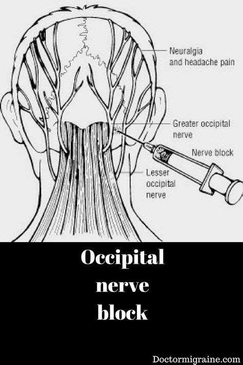 As 25 Melhores Ideias De Occipital Nerve Block No Pinterest