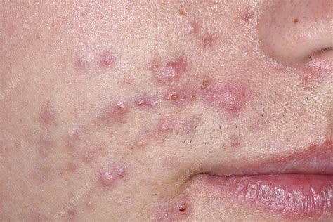 Acne Stock Image C0263258 Science Photo Library