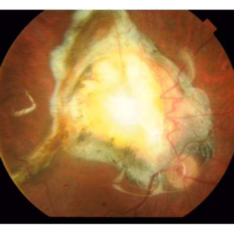 Color Photo Of The Right Eye Showing Temporal Exit With Macular