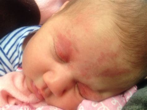 Anyone Elses Lo Have A Bruised Face After Birth Pic Babycenter