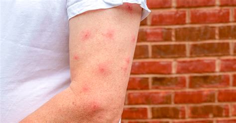 Mosquito Bite Blisters What Causes Them And How To Treat Them