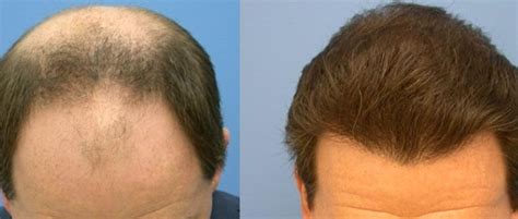Hair loss can be due to many causes, it is important is identify the cause and get hair loss treatment! Phytage Labs Rescue Hair 911 Review: Hair Growth Formula ...