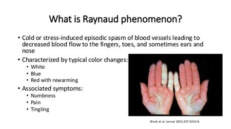 Raynaud Phenomenon And Digital Ulcers In Scleroderma