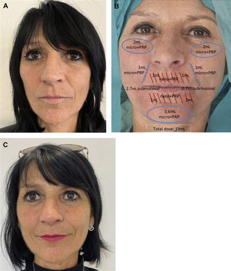 Fat Grafting For Treatment Of Facial Scleroderma Clinics In Plastic