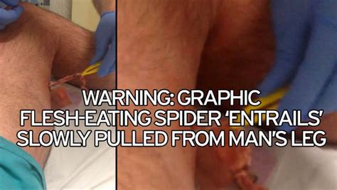 Care guide for black widow spider bite. Gruesome pictures show footballer James Gray's injuries ...