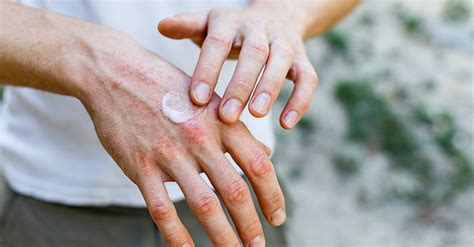Dry Skin On Hands Causes Prevention And Cure Okeeffes Okeeffes