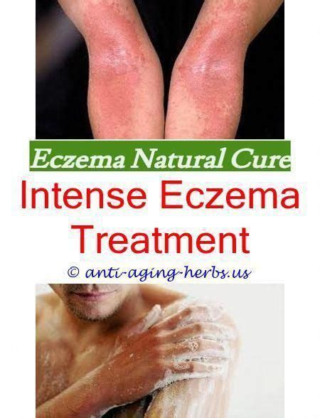 Pin On Nummular Eczema