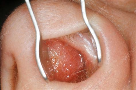 A deviated septum may cause health complications such as difficulty breathing. Nasal Septum, Angioma - Stock Image - C014/4404 - Science ...