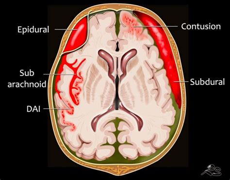 The Radiology Assistant Traumatic Intracranial Hemorrhage