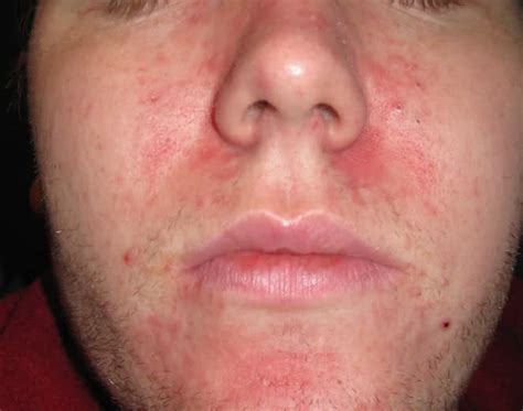 Red Rash On Nose Dorothee Padraig South West Skin Health Care