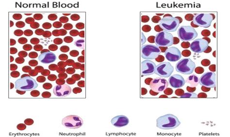 Adult Acute Myeloid Leukemia A Possible Relation To Disease Invasion