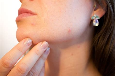 How To Treat The Most Common Bacterial Skin Infections