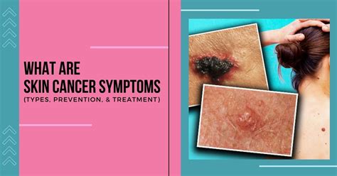 Skin Cancer Symptoms Types Prevention And Treatment