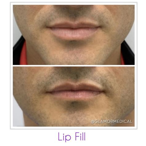 Lip Augmentation Before And After At Glamor Medical