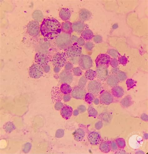 Pas Stain In Acute Erythroid Leukemia Aml M6