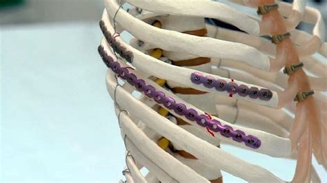Fractured ribs take their own time to heal.every time you a breathe the rib cage move in words and out words. New 'rib plating' procedure helps patients of broken ribs ...