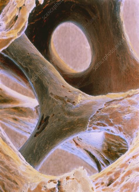 Coloured Sem Of Cancellous Spongy Bone Tissue Stock Image P105