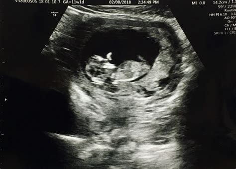 Our Baby Waved At Us During Our Second Ultrasound At 11 Weeks And 1 Day
