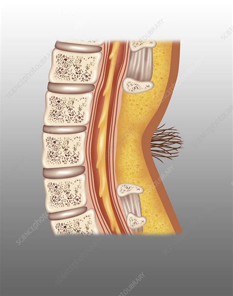 Spina Bifida Occulta Illustration Stock Image F0318205 Science