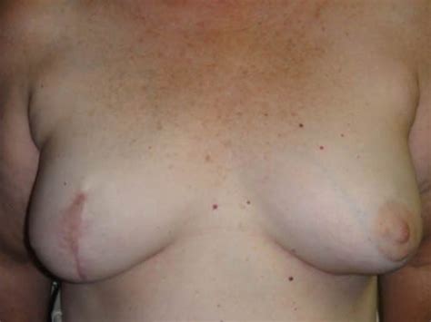 Before And After Breast Reconstruction Patient 08 Photos Dr Eva
