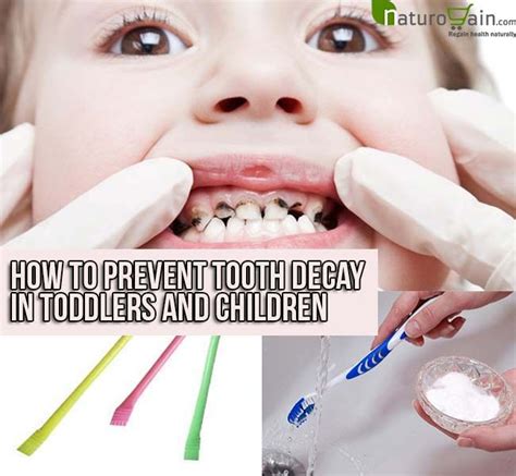 Prevent Tooth Decay In Toddlers And Children Baby Tooth Decay Tooth