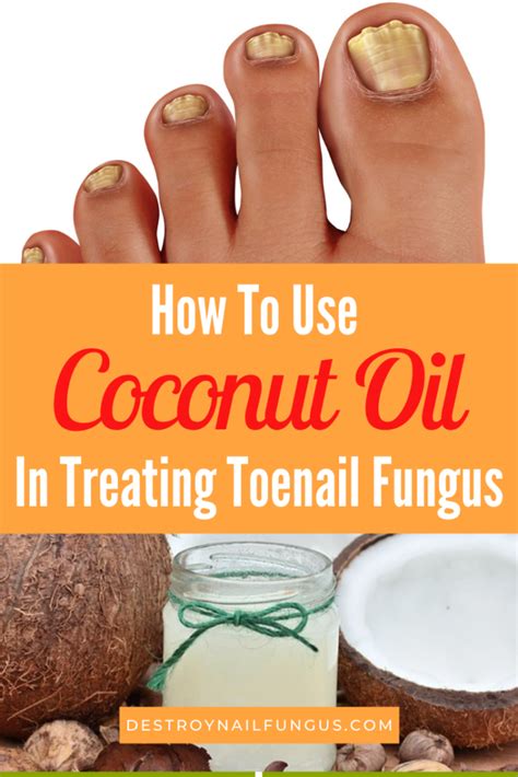 All of which promotes healthy skin, hair and nails. 5 Amazing Ways To Use Coconut Oil For Toenail Fungus ...