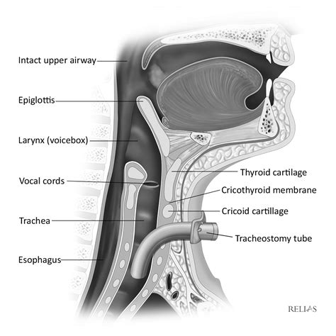 Tracheostomy Placement Diagram