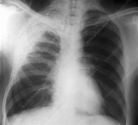 Maybe you would like to learn more about one of these? Pleurisy, X-ray - Stock Image - C026/9937 - Science Photo Library