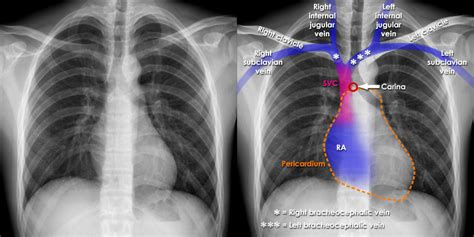 Chest X Ray Tubes Cv Catheters Position