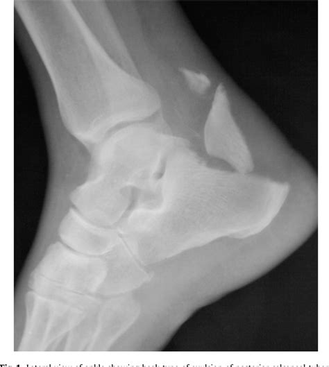 Figure 1 From Calcaneal Tuberosity Avulsion Fracture An Unusual