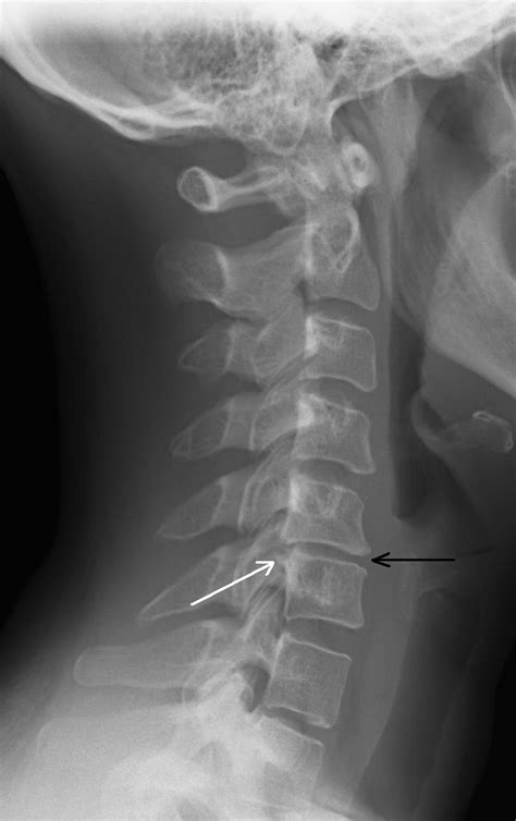 Cervical Radiculopathy Pinched Nerve In Neck Colorado