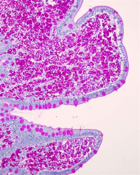 Whipples Disease Small Bowel Biopsy Histology Slides Bowels