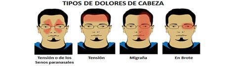 Tipos De Dolor De Cabeza Y Como Diferenciarlos F Cilmente Mi