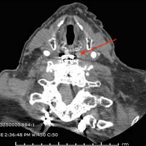 Cranial Cervical And Thoracic Computed Tomography Angiogram Revealed